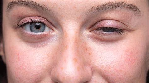 FDA Approves First-Ever Myasthenia Gravis Treatment For Children—A Game ...