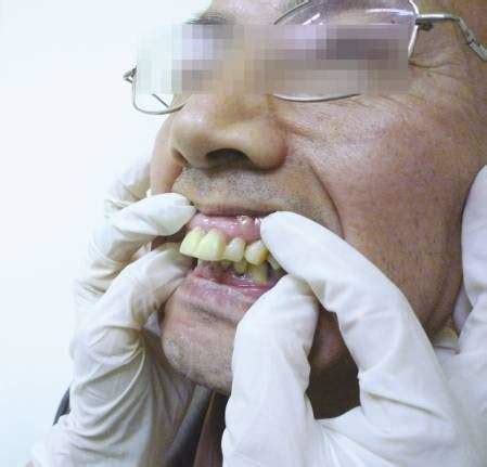 原来看牙性龅牙和骨性龅牙的对比照就能判断出两者区别啊 牙科行业资讯 - 口腔新资讯 - 牙齿矫正网