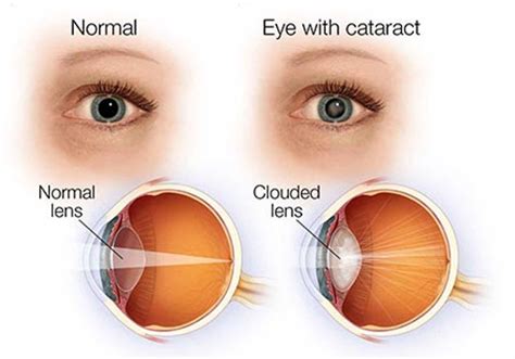 UNDERSTANDING CATARACT