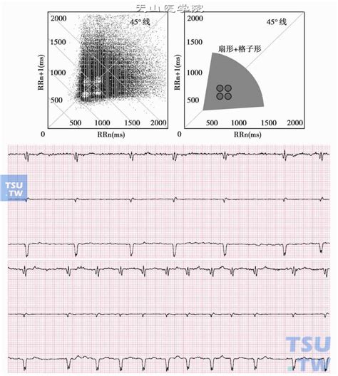 【附图】 心房颤动与扑动的心电散点图 _心电图学 | 天山医学院