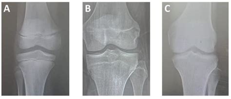 Bone Age Determination of Epiphyseal Fusion at Knee Joint and Its ...