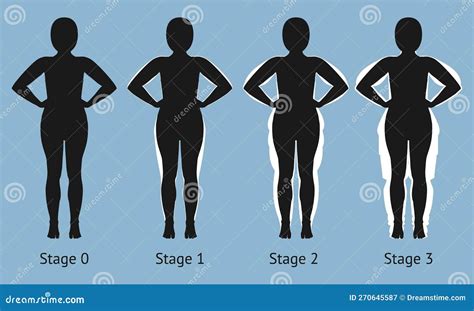 Women S Body in Different Stages of Lipedema Stock Vector - Illustration of syndrome, lipoma ...