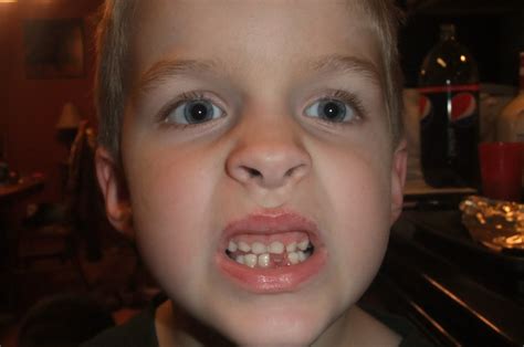 Image result for Lost Tooth