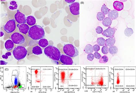 Acute Myelomonocytic Leukemia