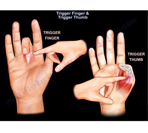 Trigger finger and trigger Thumb — OrthopaedicPrinciples.com