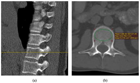 Diagnosis of Osteoporosis by Quantifying Volumetric Bone Mineral ...