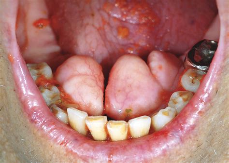 Mandibular Tori | New England Journal of Medicine