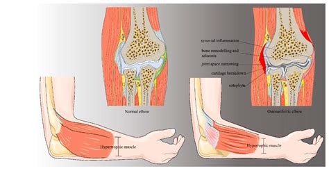 An Overview of the Pathogenesis and Treatment of Elbow Osteoarthritis