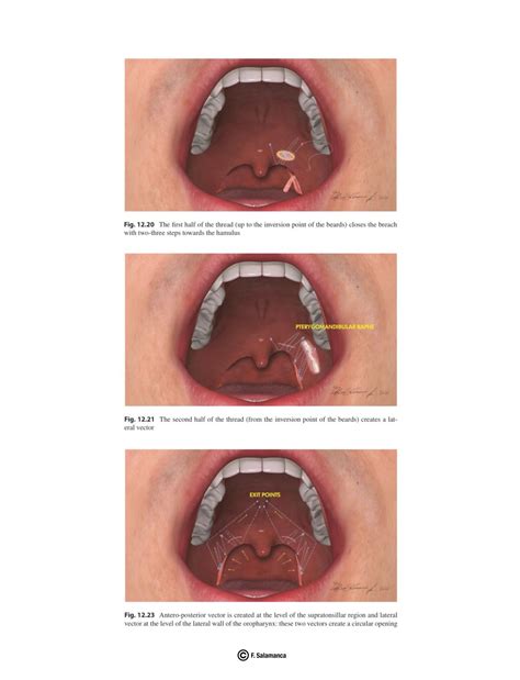 🇮🇹🇬🇧 (ENGLISH BELOW) Caso clinico: faringoplastica anterolaterale con ...
