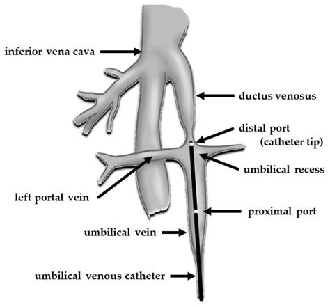 Umbilical Vein Calcification Associated with Double-Lumen Catheter ...
