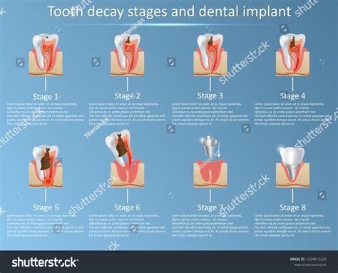 Dental Implant Infection Images: Browse 573 Stock Photos & Vectors Free Download with Trial ...