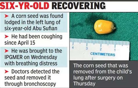 Sskm Extracts Corn Seed From Child’s Lung After A Wk | Kolkata News ...