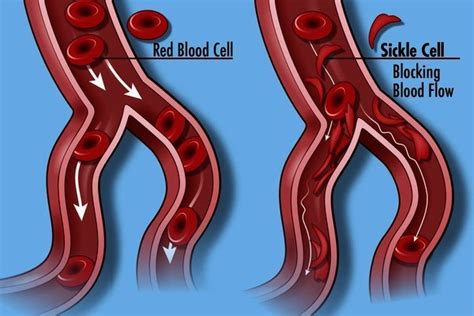 ICKLE CELL ANAEMIA (SCA) | UPSC Current Affairs | IAS GYAN