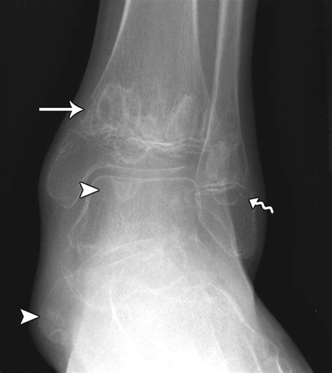 Imaging of Chronic Recurrent Multifocal Osteomyelitis | RadioGraphics