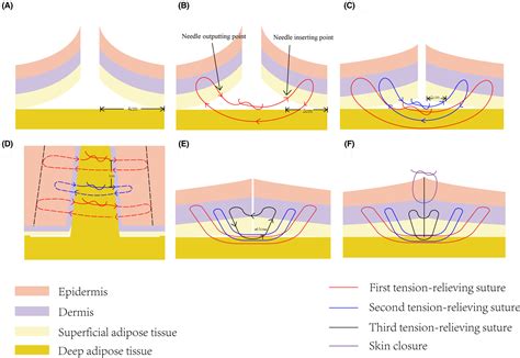 Multi‐gradient buried vertical mattress suture, an effective suture ...