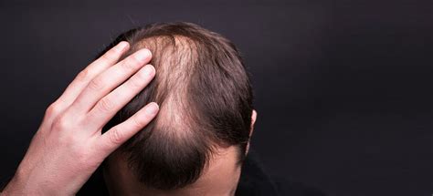 Hair Care And Homoeopathy | Reckeweg India