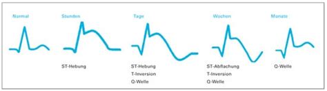 EKG bei akuten Koronarsyndromen