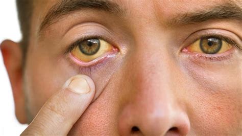 Signs Of Fatty Liver Disease That Show On Your Face | OnlyMyHealth