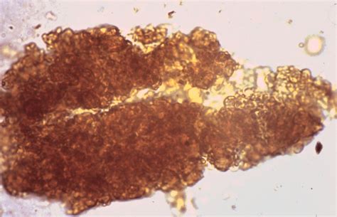 Red blood cells casts