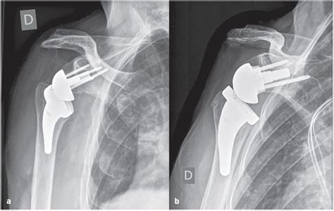 Patient-specific lateralization, glenoid offset, implications and oper ...