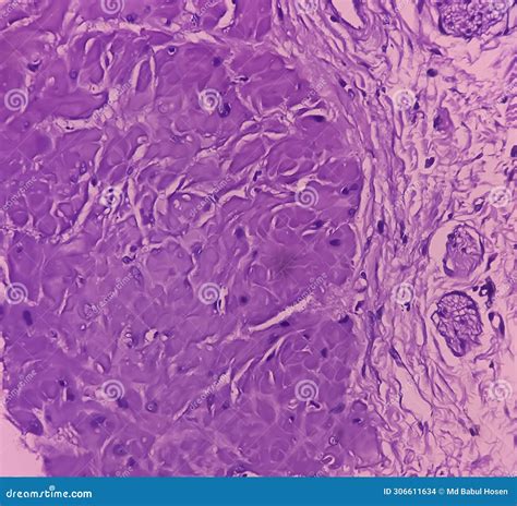 Prostatic Chips (TURP): Adenocarcinoma. it Reveals an Infiltrating Adenocarcinoma. Prostate ...