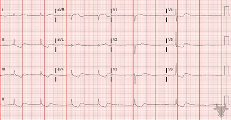 Digitalis On Ecg at Toby Middleton blog