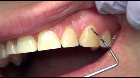 Image result for Calcium Buildup Front Teeth