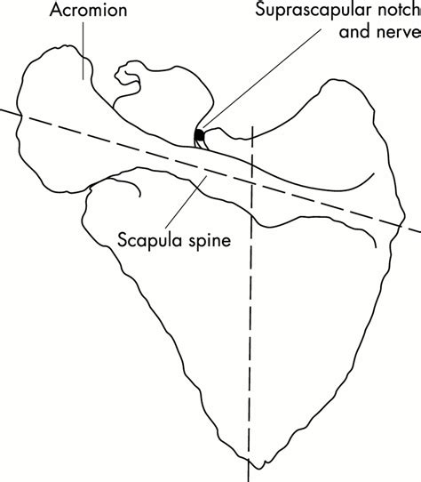Suprascapular nerve block (using bupivacaine and methylprednisolone ...
