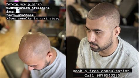 Scalp Micropigmentation Images Before and After Results & Reviews