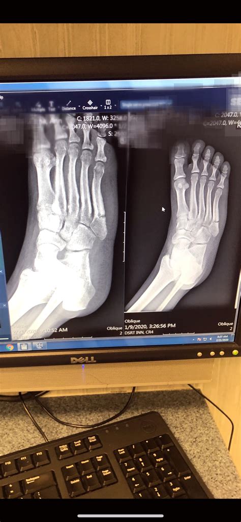 Dr wants me to walk on broken foot ?!? (Pic include) 18 years old have ...
