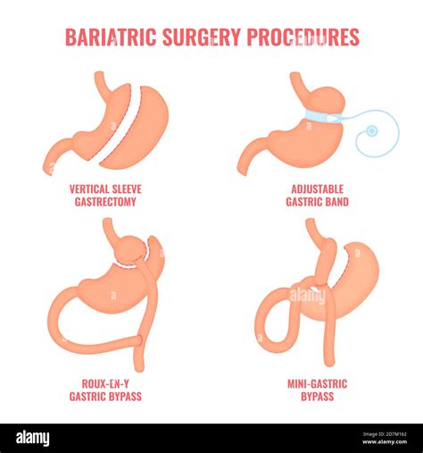 Sleeve Gastrectomy Surgery Vs Gastric Bypass at Blair Martin blog
