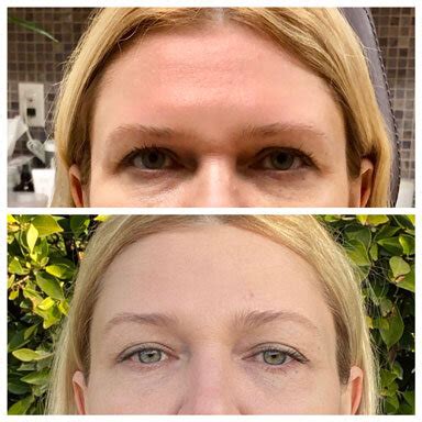 Image result for Thread Brow Lift Procedure