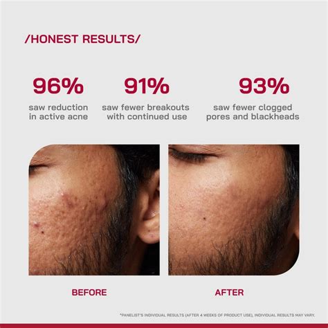 2% Salicylic Acid Anti-Acne Serum for Acne & Clogged Pores