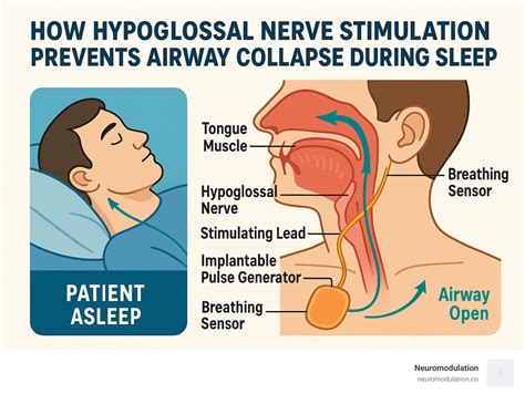 Hypoglossal nerve stimulator therapy: Your 2025 Breakthrough