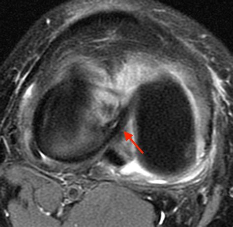 Bucket-handle Tear of the Meniscus | Radsource