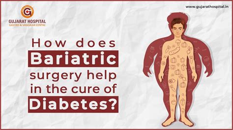 How does Bariatric surgery help in the cure of Diabetes?