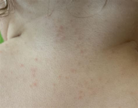 Red Bumpy Rash On Back Of Neck at Betty Ammerman blog