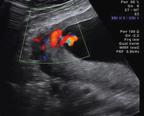 Placenta and Umbilical Cord Imaging - Clinical Tree