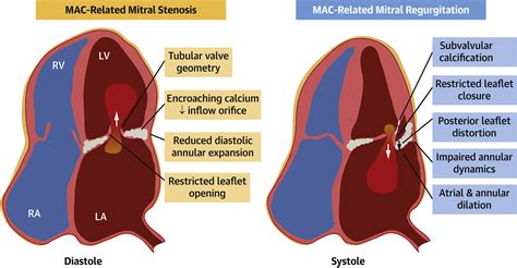 Mitral Annular Calcification and Valve Dysfunction: Insights and Future Directions - Journal of ...