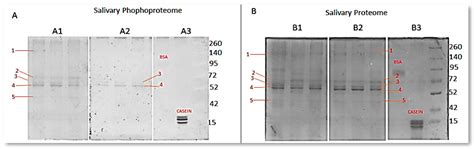 Gingival Enlargement Associated with Orthodontics Appliance Increases ...