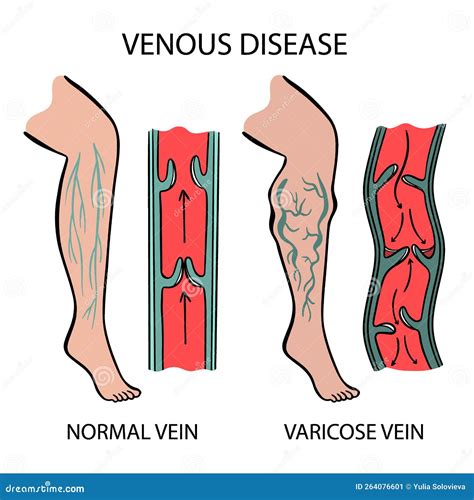 Varicosities Diagram