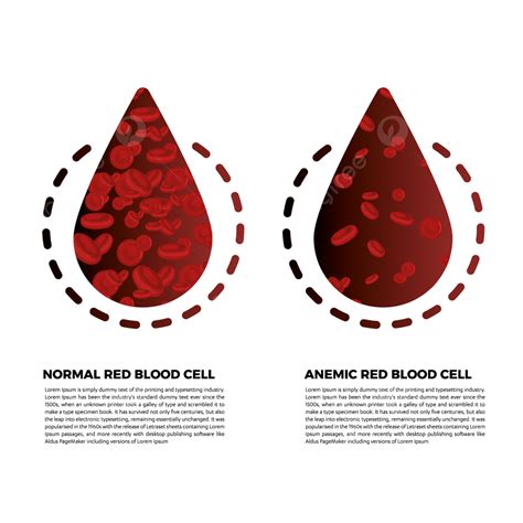 Anemia Iron Red Blood Cell Medical Vector Illustration, Anemia, Blood ...