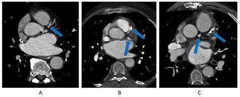 Prevalence of Coronary Artery Calcification on Pre-Atrial Fibrillation ...