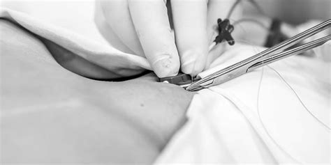 Image result for Purpose of CVC Line