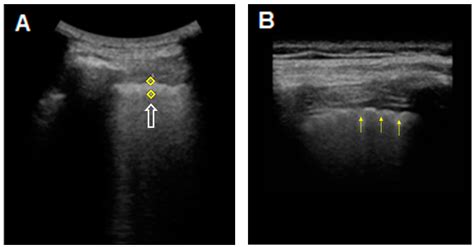 The Role of Transthoracic Ultrasound in the Study of Interstitial Lung ...