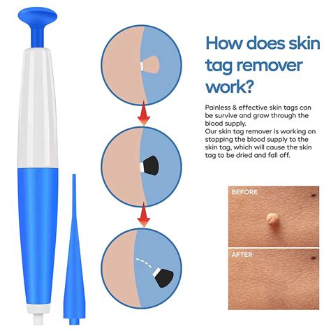 Skin Tag Remover Kit - Easy Application Device for Small to Medium Skin Tags (2mm-5mm) - Blue ...