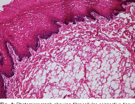 Lipoma Histology