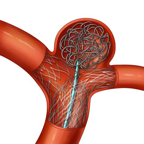 What Is A Coil For Aneurysm at Anthony Barajas blog