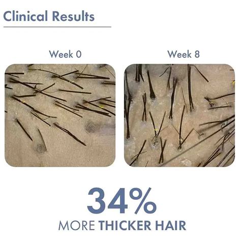 Hair Growth Serum | Best Hair Growth Serum for Men and Women