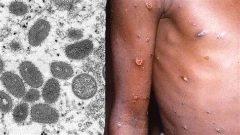 Sick persons from Monkeypox-affected countries will be isolated; Centre ...
